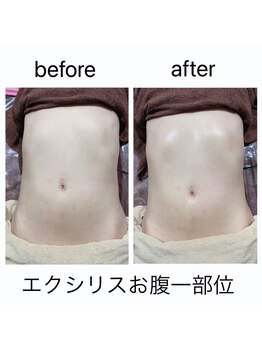 リベル(Liber)/痩身マシンエクシリス【腹部前】