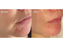 ラヴィス(RAVIS)/ほうれい線、たるみ改善！