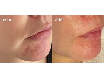 ラヴィス(RAVIS)/ほうれい線、たるみ改善!