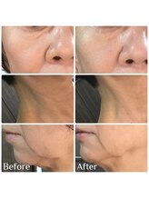 クリスタルボウ(Crystal BEAU)/シワたるみ改善コース1回のみ