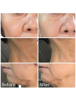 クリスタルボウ(Crystal BEAU)/シワたるみ改善コース1回のみ