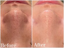 サロンドフェイス(Salon de Faith)/ハーブピーリング