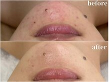 サロン ド ブラン アオヤマ(Salon de BLANC AOYAMA)/クリスティーナハーブピーリング