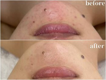 サロン ド ブラン アオヤマ(Salon de BLANC AOYAMA)/クリスティーナハーブピーリング