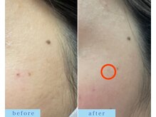 アフロディーテ(APHRODITE)/ビフォーアフター