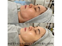 韓国で話題のLDM/肌の土台から即効リフトアップ＆肌質改善／赤羽