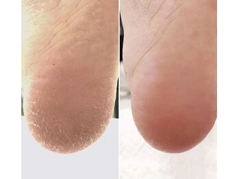 ルーチェ バイ フェリシア(LUCE by Felicia)/カサカサかかとにさよなら☆