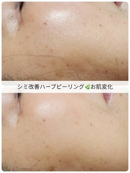 サロンベイア(salon Beia)/シミ改善ハーブピーリング