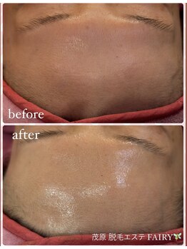 フェアリー/炭酸×プラズマフェイシャル