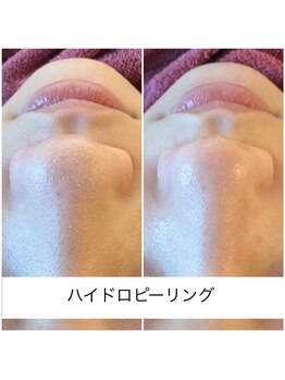 サロン ヴィーナス(VENUS)/ハイドロピーリング鼻回りの例