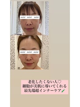 ミント(mint)/10億個のエクソソームを高配合