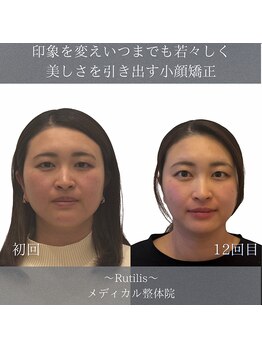 ルチルス(Rutilis)/むくみ/たるみケア/肌質改善