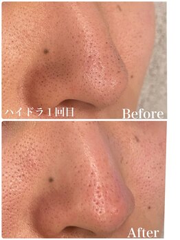 アカヌケ(AKANUKE)/いちご鼻卒業♪毛穴洗浄