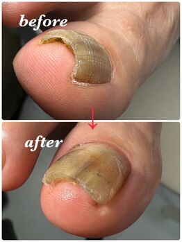 アールインネイル(R-in Nail)/巻き爪緩和ケア