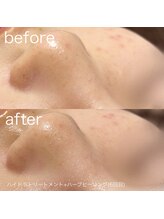 ルルラ リコ(lulula rico)/症例写真/ハイドラ毛穴洗浄