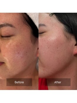 マインエム(mine.m)/肌荒れとニキビ