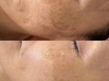 クラルテ(CLARTE)の雰囲気（シミ・乾燥でお悩み。くすみ改善でトーンUP！ダクトピール1回）