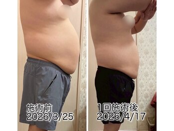 クールスパ(COOL SPA)/男性お腹症例