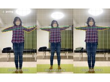 エヴォストレッチ(EVO STRETCH)/60代女性【肩甲骨・手首の痛み】