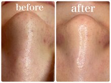 ヒメミ(Himemi)/毛穴エクストラクションtete式