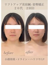 めい鍼灸院/リフトアップ美容鍼