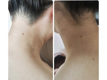 キナリ(kinari)/うなじワックス脱毛