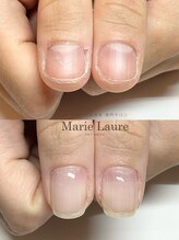 マリーロール 梅田店(Marie Laure)/自爪育成/深爪矯正/ネイルケア