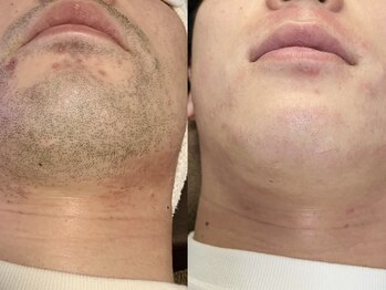 スタジオサンハチゴ(studio-385)/【ひげ脱毛】人気NO.1メニュー