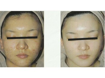 ガネェーシャ(Ganesha)/水光ピーリング ビフォアフ