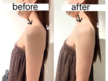 アンワインド(UNWIND)/二の腕も浮腫むのはご存知?・・