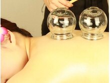 【冷え/飲酒/喫煙等の不調を解消】★背中カッピング(吸玉)40分¥4500→¥3990