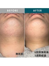 モモナ(Momona)/佐世保/脱毛/髭脱毛/全身脱毛