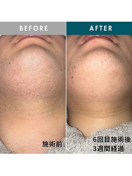 モモナ(Momona)/佐世保/脱毛/髭脱毛/全身脱毛