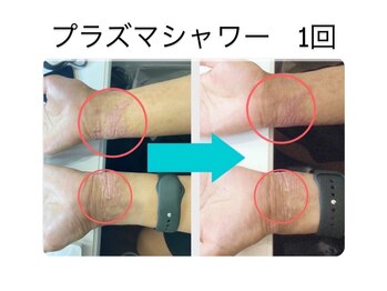 ビービー(BB)/プラズマシャワー＋導入