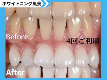 鹿児島ホワイトニング/Before→After