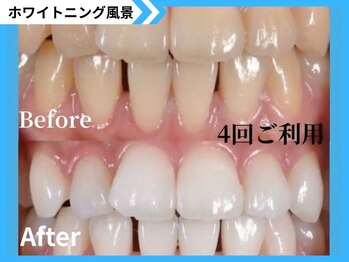 鹿児島ホワイトニング/Before→After