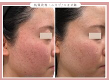 グレースエール トータルビューティーサロン(Grace Aile)/肌質改善