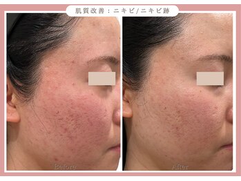 グレースエール トータルビューティーサロン(Grace Aile)/肌質改善