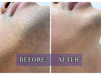 ルブレ Ginza5店(RUBURE)/【ヒゲ脱毛ビフォアフター】