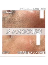 グランクレール トウキョウ(GRANDCLAIRE.TOKYO)/ヒゲ脱毛