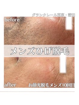 グランクレール トウキョウ(GRANDCLAIRE.TOKYO)/ヒゲ脱毛