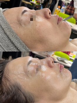 レイ(Lei)/ハーブピーリング/ニキビ/ルヴィ