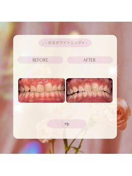 プラスビー 2号店(+b)/ホワイトニングビフォーアフター