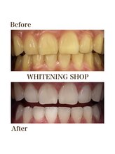 ホワイトニングショップ 岸和田店/お客様のBefore  After