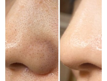 サイ(Sai)/before→after