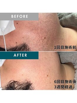 モモナ(Momona)/佐世保/脱毛/髭脱毛/全身脱毛