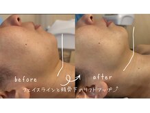 サロン リノ(salon rino)/光フェイシャルリフトアップ