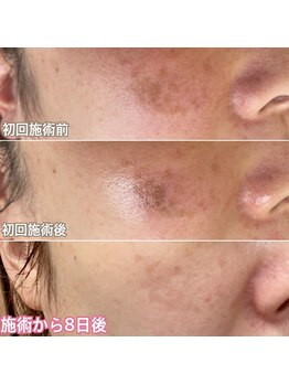 クレアナ ザ ビューティー(KULEANA the beauty)/光フォト