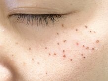 ジーニー(genie)/シミケア後