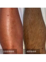 ビューティリュクス(beauty luxe)/全身脱毛